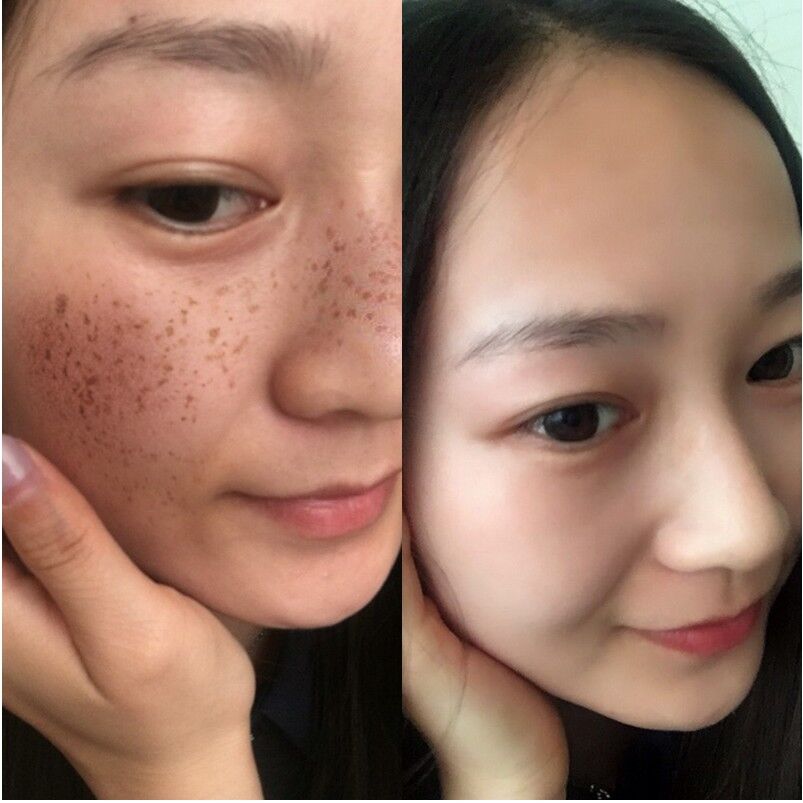 如何去雀斑生活妙招_怎样去遗传性雀斑小妙招_如何去雀斑生活妙招